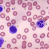 Monócitos Altos ou Baixos no Exame de Sangue - O Que Isso Significa?