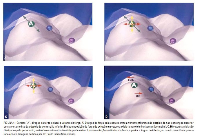 PDF: Ajuste oclusal na Ortodontia: por que, quando e como?