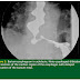 Peroral Endoscopic Myotomy (POEM) for Esophageal Achalasia