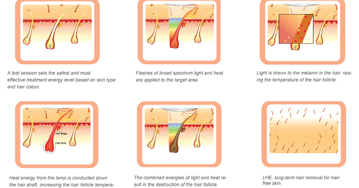 Фотоэпилятор отзывы до и после Kona Laser Hair Removal Clearance xn--h1aahyg1df.xn--p1ai