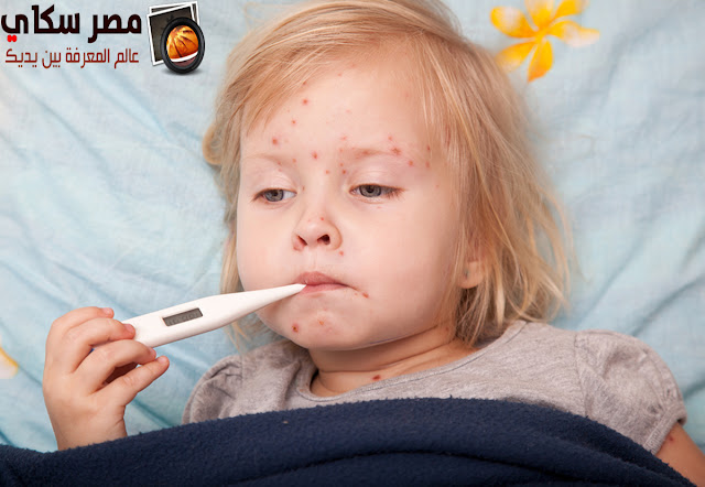كيفية التمييز بين مختلف أنواع الطفح الجلدى Skin rash كيفية التمييز بين مختلف أنواع الطفح الجلدى Skin rash