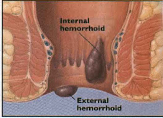 Tips Herbal Mengatasi Ambeien Sudah Ada Benjolan, Ambeien Wasir Parah Kambuh, Apakah Wasir Sudah Parah Bisa Sembuh Total?