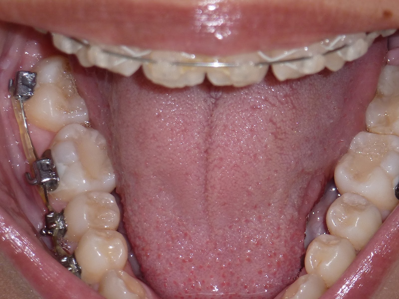 My Damon Clear Braces Week 15 Third wire change and power chains!