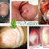 Obat Kencing Nanah Herbal De Nature Paling Ampuh