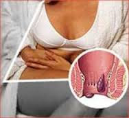 Obat Wasir Untuk Ibu Menyusui Obat Wasir Untuk Ibu Menyusui