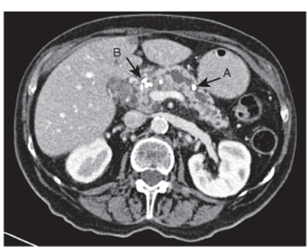 Internal Medicine Pathophysiology of Chronic Pancreatitis