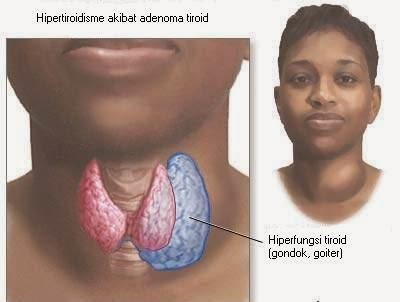 Macam Macam Penyakit Dengan Benjolan Di Leher Doclol