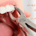 الطرق الصحيحة لوقف نزيف الدم بعد خلع الاسنان 