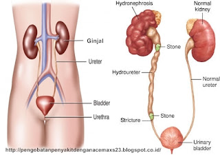 Obat Ginjal Bengkak Obat Ginjal Bengkak