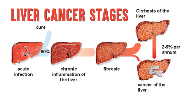 Billboards Hub How Long Can You Survive With Liver Cancer