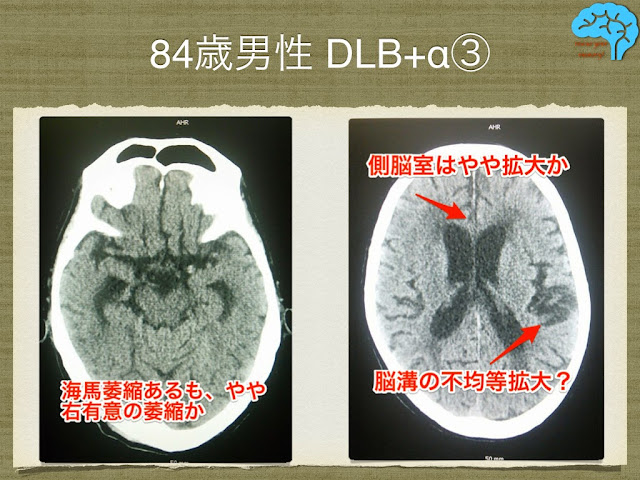 頭部画像はDLB典型例ではない