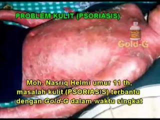Obat Psoriasis Obat Psoriasis