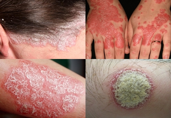Obat Untuk Menyembuhkan Penyakit Psoriasis Obat Untuk Menyembuhkan Penyakit Psoriasis