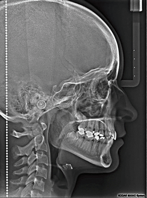 Radiografía Lateral de Cráneo