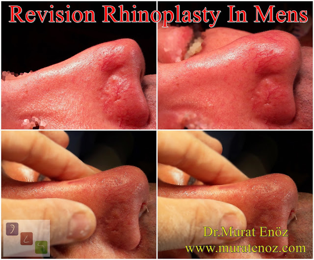Revision Nose Job Surgery for Men - Revision Male Rhinoplasty - Men's Revision Rhinoplasty - Revision Nose Reshaping for Men - Mens Revision Rhinoplasty - Revision Nose Job Rhinoplasty for Men - Best Revision Rhinoplasty For Men Istanbul - Revision Nose Aesthetic for Men - Male Revision Nose Operation - Male Revision Rhinoplasty Surgery in Istanbul - Male Revision Rhinoplasty Surgery in Turkey - Male Revision Nose Aesthetic Surgery - Revision Rhinoplasty In Mens