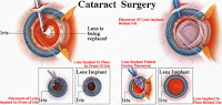cataract eye surgery in India
