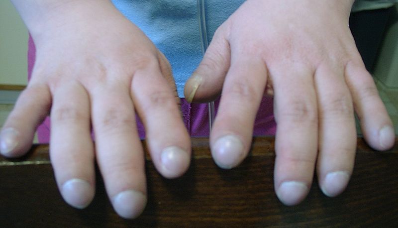 diabetes de los dedos del clubbing en niños