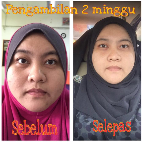 perlashine kapsul mutiara testimoni