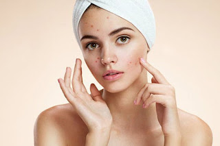 Como Se Quita El Acne Como Se Quita El Acne