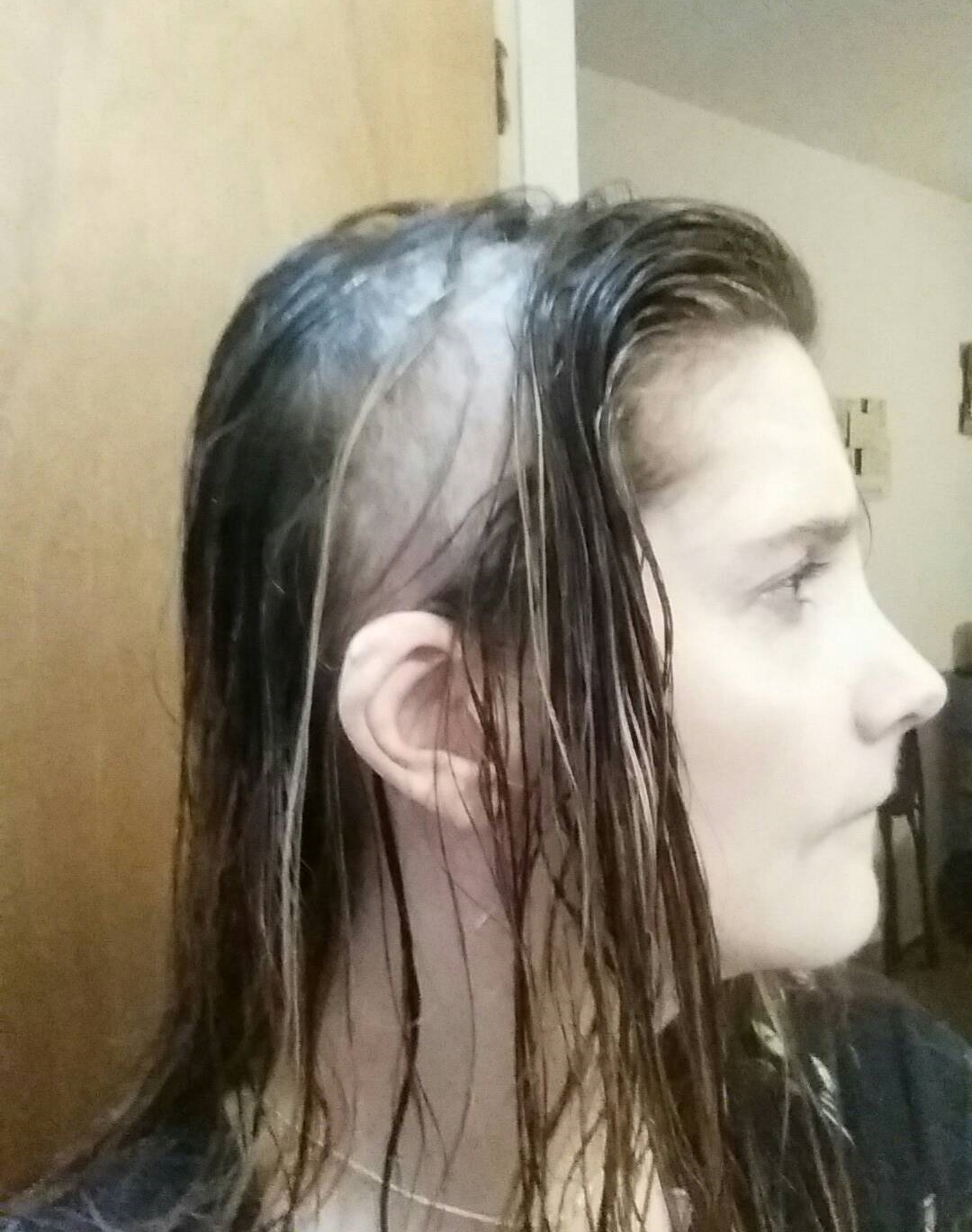 My s cap one stitch at a time lupus and hair loss