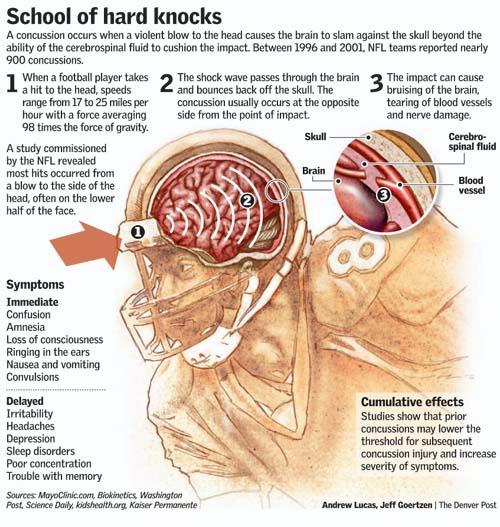 Concussions In Sports Concussions In Sports