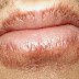 O que é Dermatite Labial ou Eczema no Lábio?