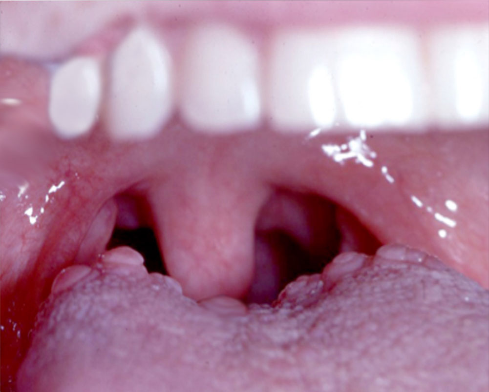 Large Bumps in the Back of the Tongue | Fauquier ENT Blog