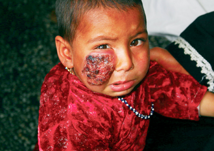 baby_leishmaniasis.jpg