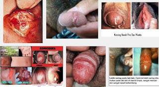 Cara Mengobati Kelamin Laki Laki Panas Dan Kencing Keluar Nanah Cara Mengobati Kelamin Laki Laki Panas Dan Kencing Keluar Nanah