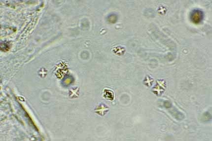 What does it mean to have amorphous crystals in urine Haematology Microscopic Examination Of Urinary Sediment Crystals Free Medical Atlas