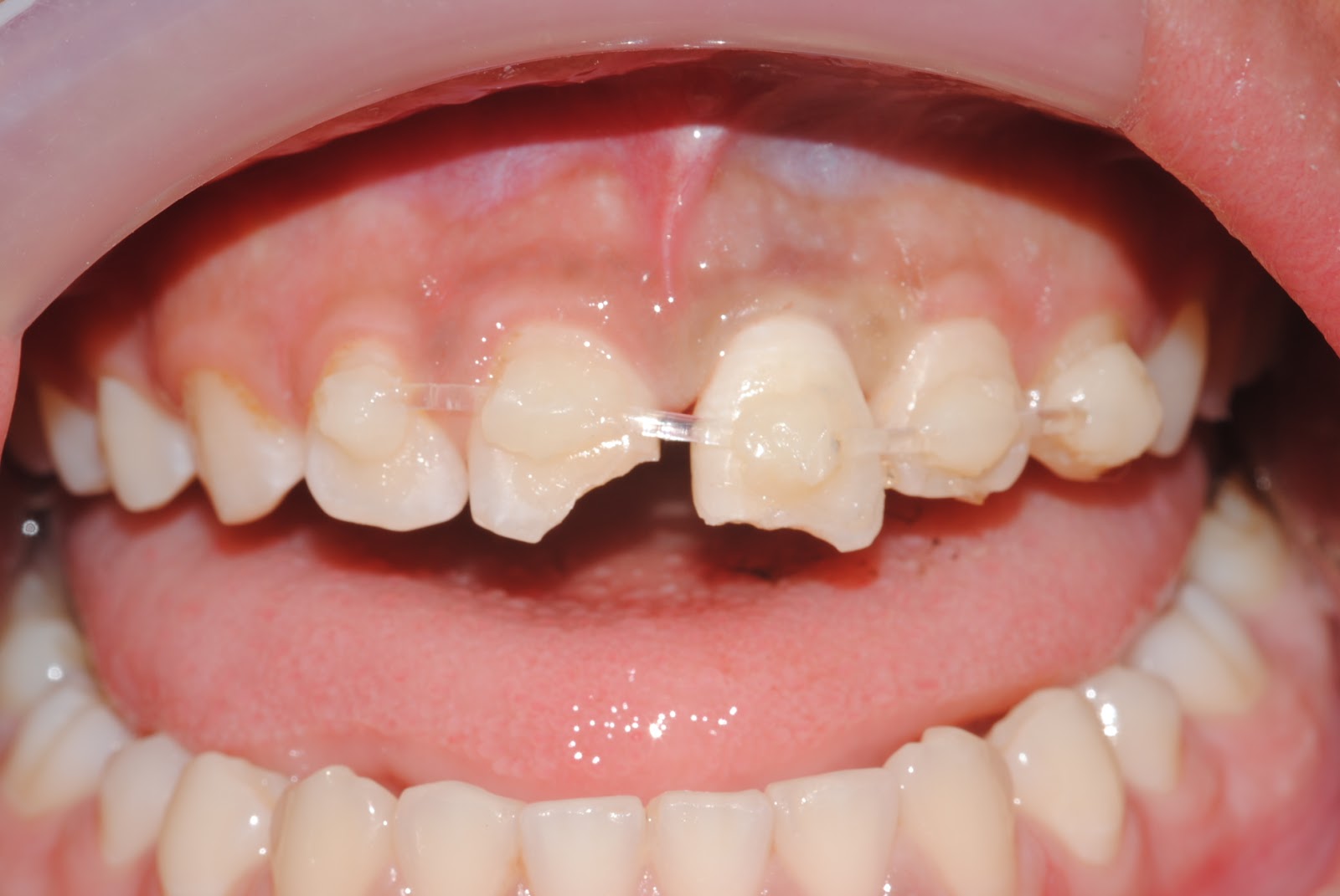 Peripécias Clínicas: B.O. do dia: Avulsão