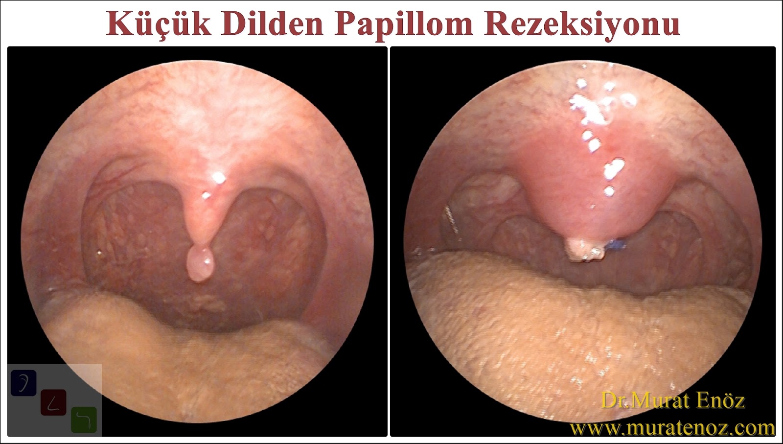 excision of uvula papilloma cpt code)