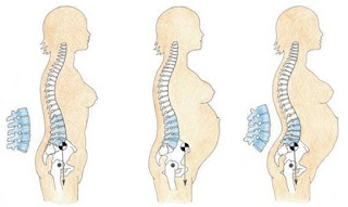 hiperlordosis embarazo