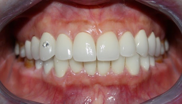 Tìm hiểu ưu điểm của răng toàn sứ Uu-nhuoc-diem-nieng-rang-mac-cai-su-1