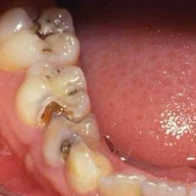 दात में कवट से बचाव कैसे करे | to prevent cavities Tooth Care Healthyho 