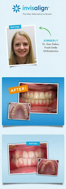 Invisalign Before and After Girl #ad #INVStraightTalk