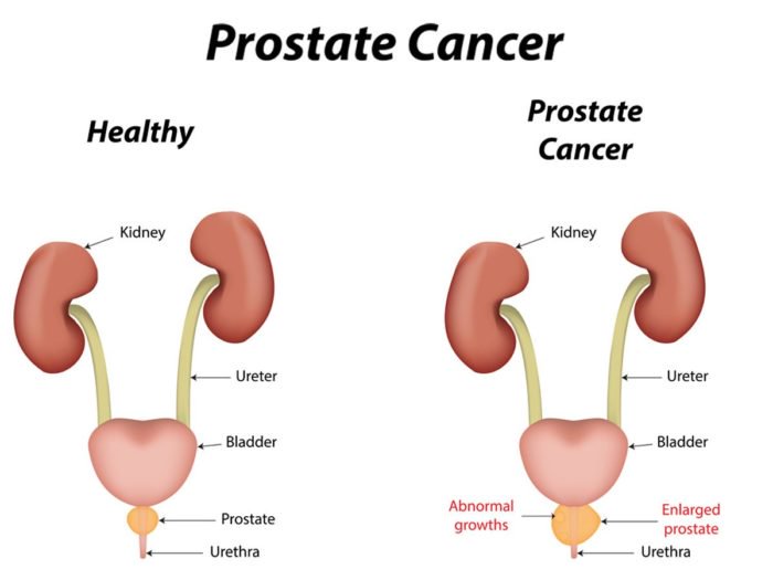 Férfi betegség krónikus prosztatitis Prostatitis 1 evőkanál