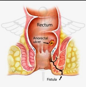 Perawatan Penyakit Fistula Ani Di Rumah Perawatan Penyakit Fistula Ani Di Rumah