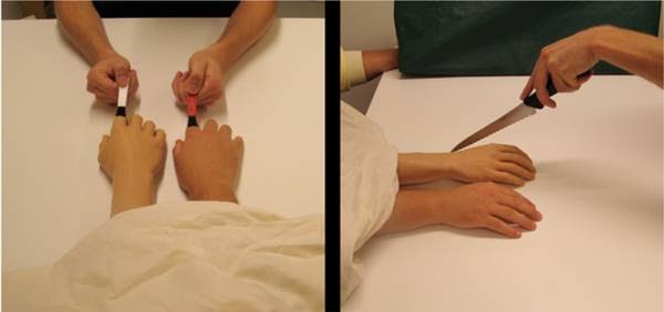 Ампутированные конечности. Болевой синдром презентация. Что такое фантомные метки. Что такое фантомные метки. Фантомные боли механизм.