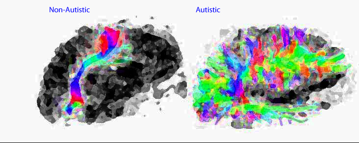 It Takes Brainsto Solve Autism >> Ann S Autism Blog Autism Brain Event Not Nastiness An Example It Takes Brainsto Solve Autism >> Ann S Autism Blog Autism Brain Event Not Nastiness An Example