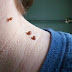 How To Remove Skin Tags With One Simple Ingredient.