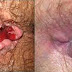 Salep dan Obat Wasir Berdarah Ampuh thumbnail
