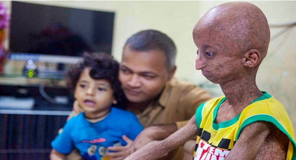 Penyakit Aneh Anak 14 Tahun Penyakit Aneh Anak 14 Tahun