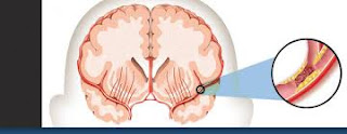gejala sakit stroke ringan, apa obatnya?, apa obat herbal stroke sebelah kanan yang manjur?, Bagaimana Mengobati Sakit Stroke Ringan?