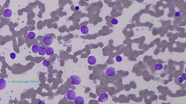 Microscopy image of Leukemia captured at 400x magnification.