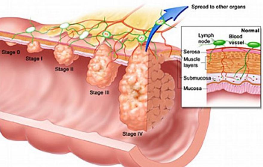 how-bad-is-stage-3-cancer-in-the-lymph-nodes-canceroz