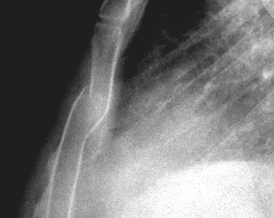 Sternal Fracture Sternum Pain After Car Accident
