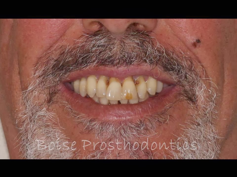 Boise Idaho Prosthodontics: Maxillary Complete Denture / Mandibular 5 ...