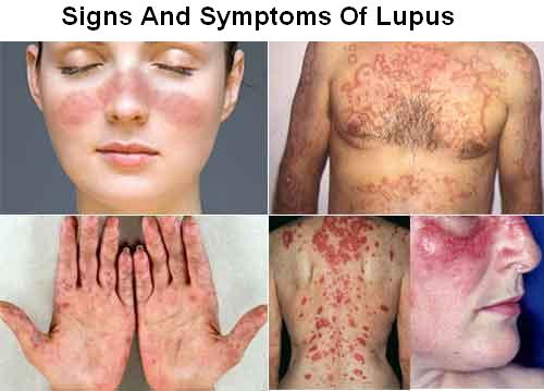 Systemic Lupus Erythematosus (SLE) Picture Lupus Rash