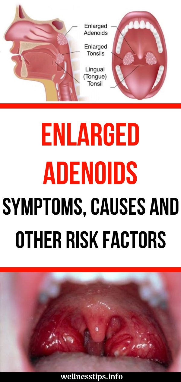 Wellness Tips Enlarged Adenoids Symptoms, Causes And Other Risk Factors